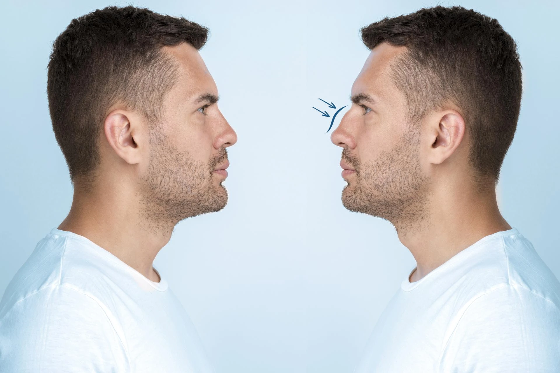 Everything You Need to Know About Non-Surgical Rhinoplasty
