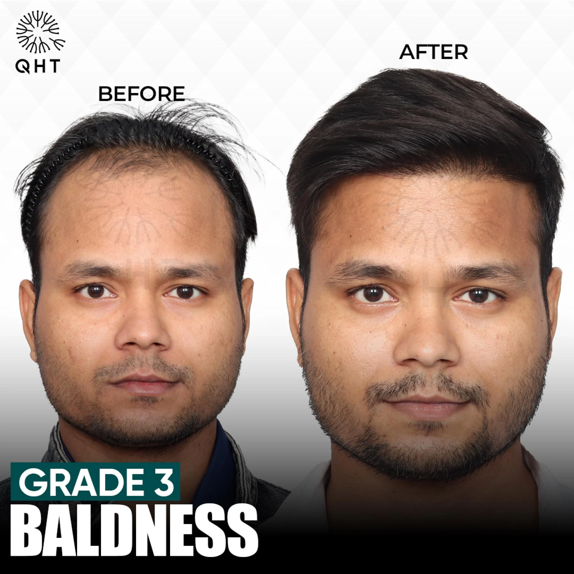 Failed Hair Transplant- Why does it happen and how to fix it?