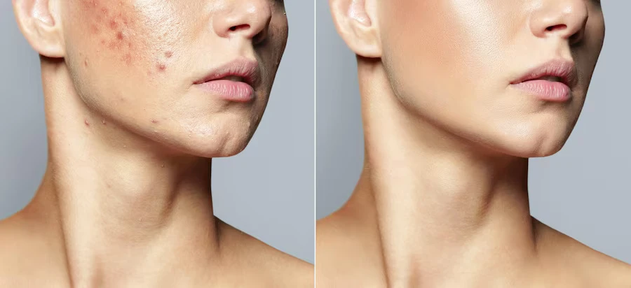 Retinol Before and After: A Personal Journey Through the Highs, Lows, and Lasting Results