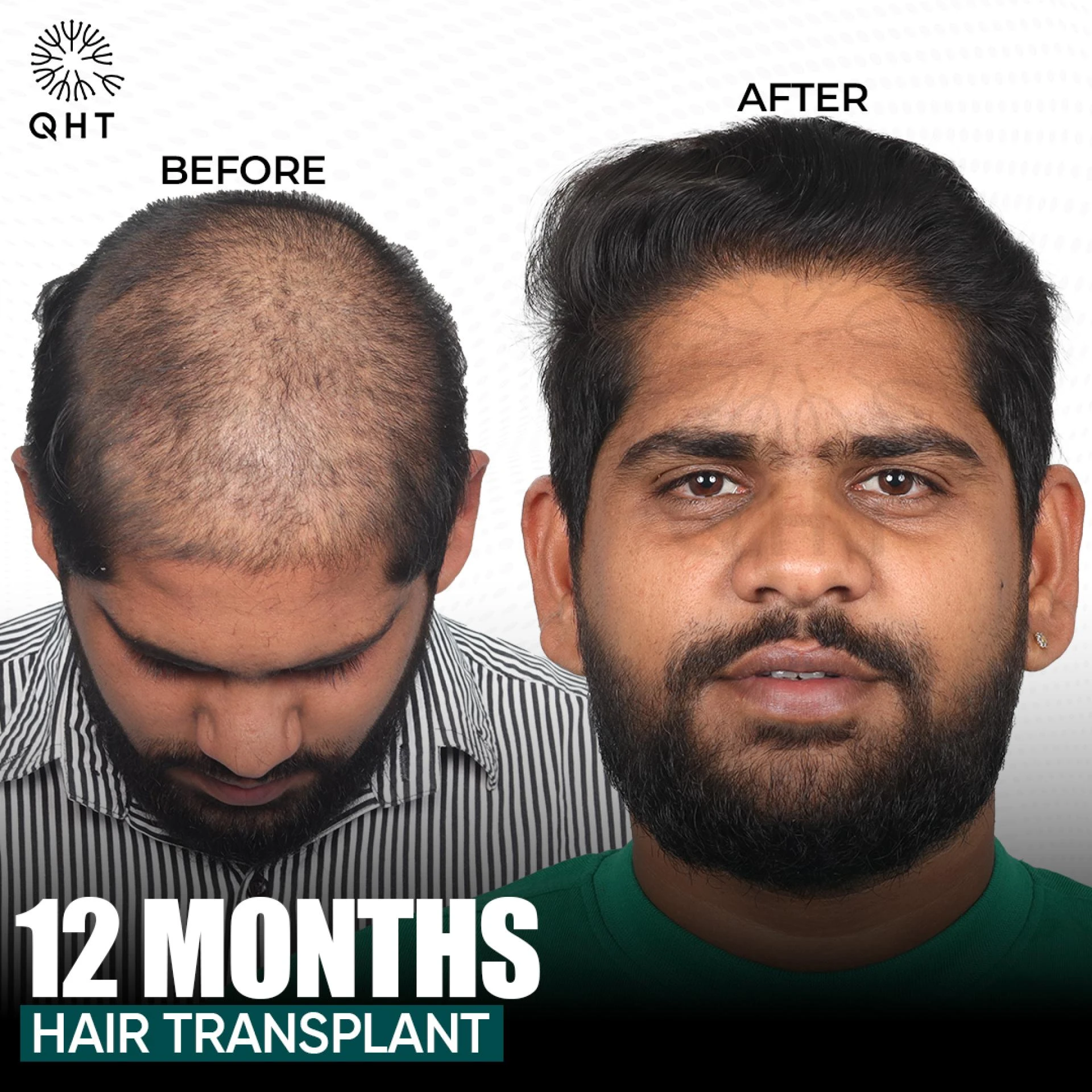 Best Hair Transplant at the Best Price – Book Your Consultation Now