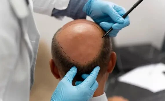 Expert Tips To Maintain Hair Transplant Results