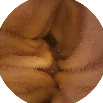 OMOM HD omom capsule endoscopy system