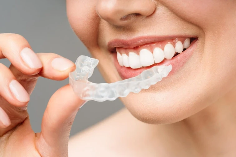 Are Smilers Clear Aligners Worth It ?