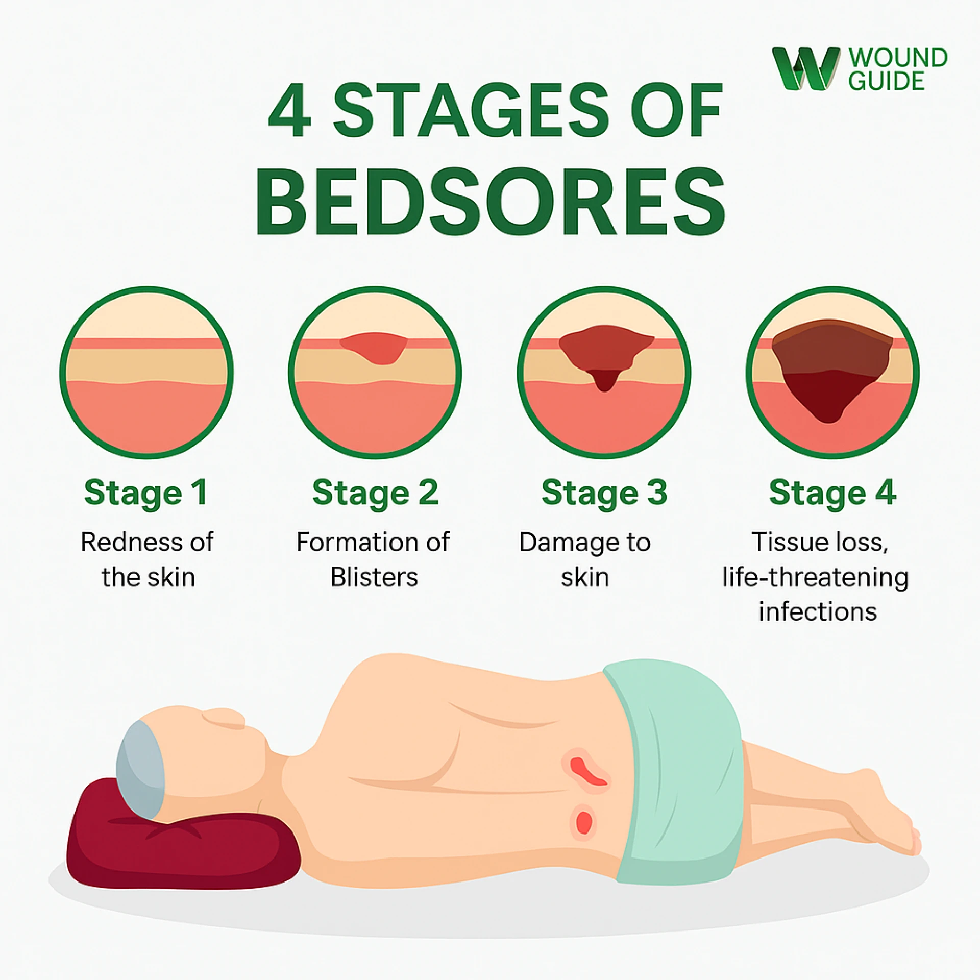 Understanding the 4 Stages of Bedsores: A Guide for Prevention and Care