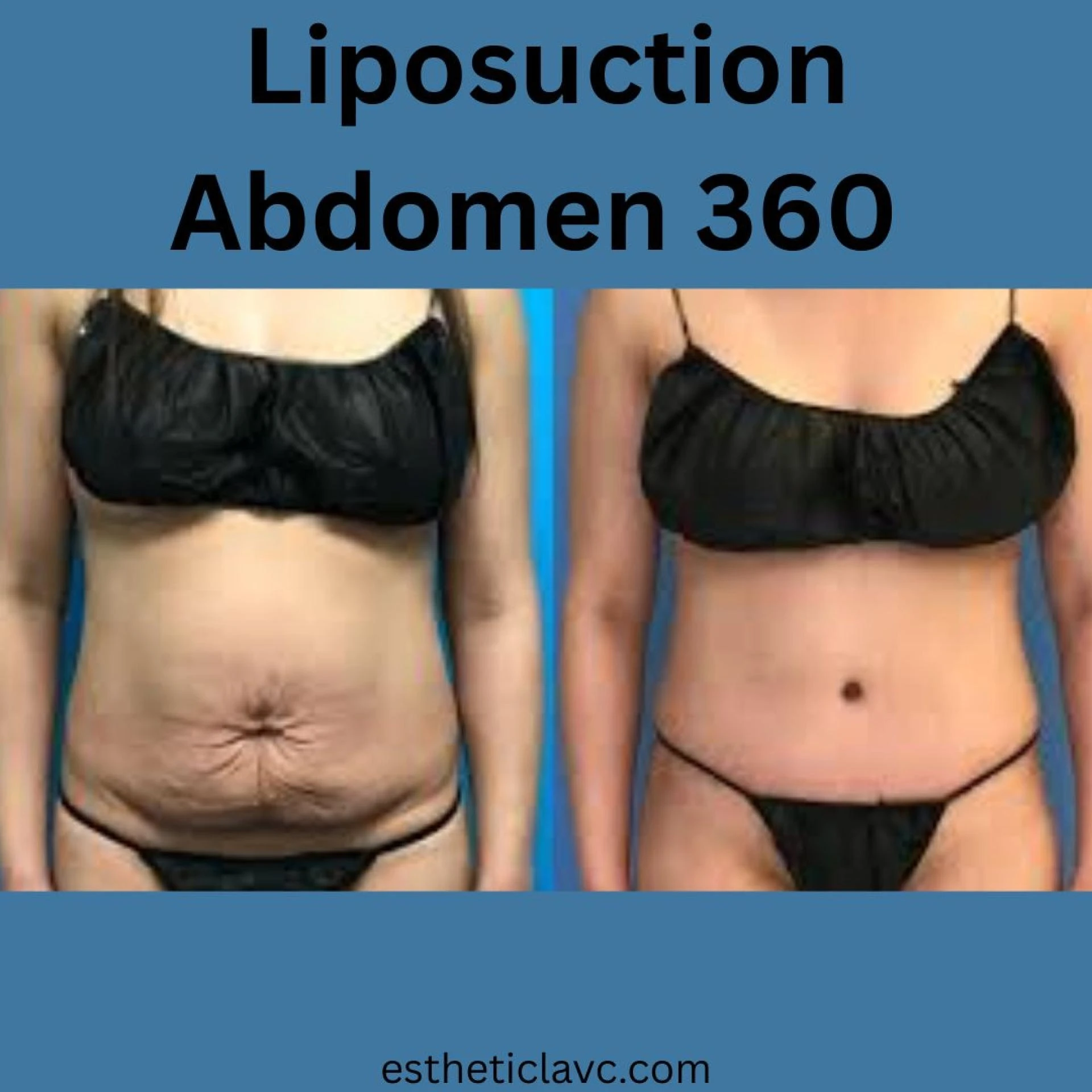What Makes Liposuction Abdomen 360 the Ultimate Fat Removal Option in Maryland? When it comes to sculpting 