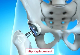 Hip Replacement Surgery in India: Affordable, Advanced, and Accessible with EdhaCare