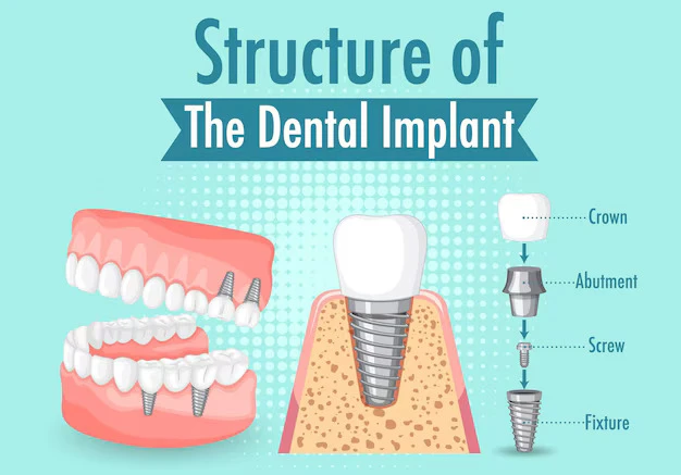 What is Dental Implant Placement Procedure ?