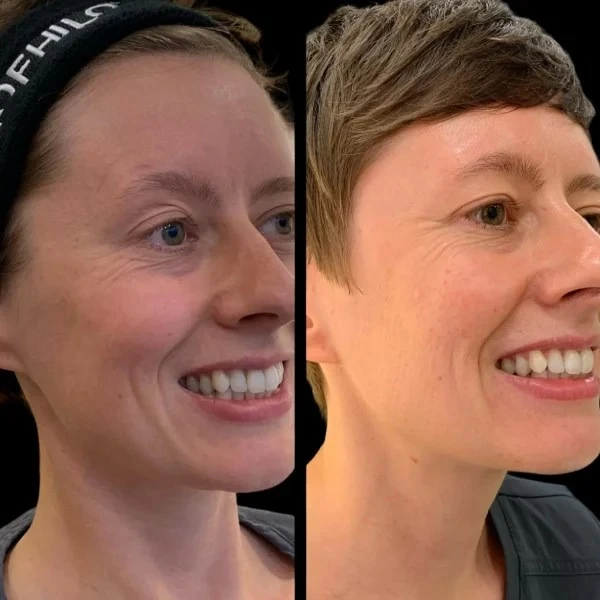 Transform Complexion with Profhilo Treatment in Dubai