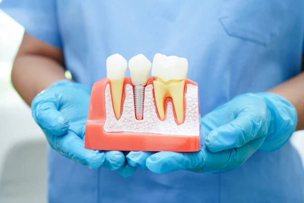What is Dental Implant Placement Procedure ?