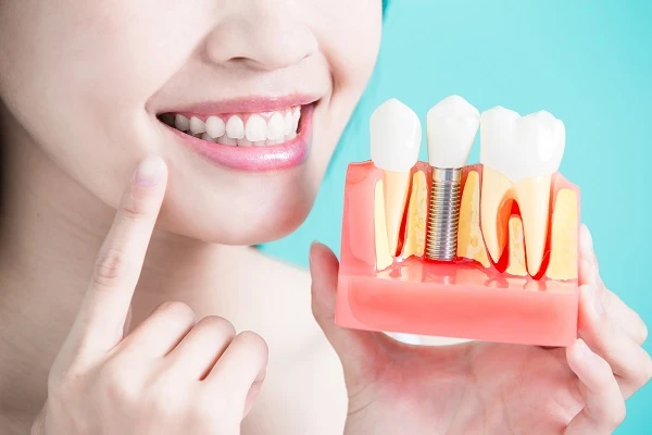 What is Dental Implant Placement Procedure ?