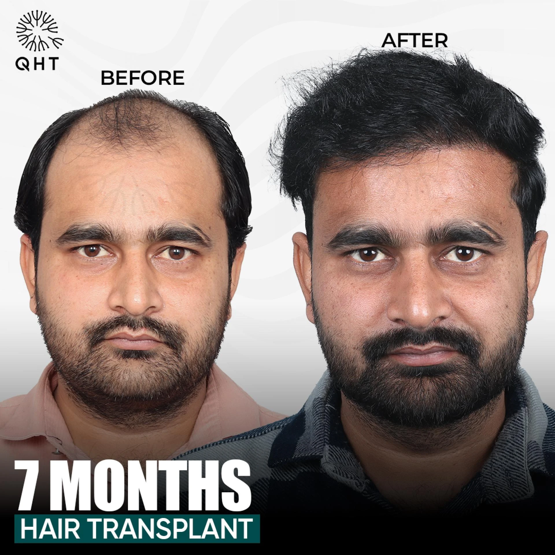 Book your slot today for the Affordable FUE Hair Transplant in India.