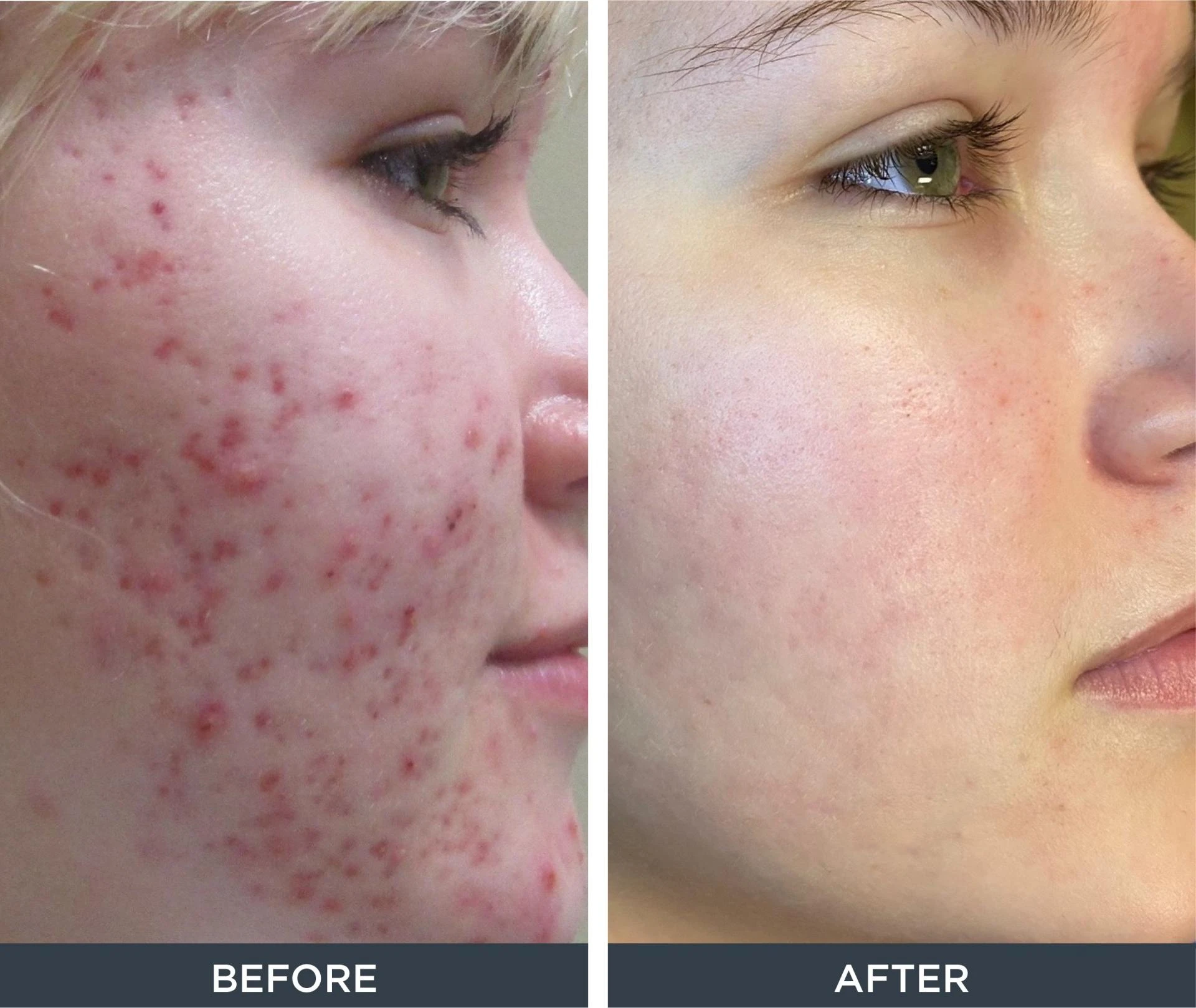 How Microneedling Is Treating Acne Scars in Peshawar Effectively