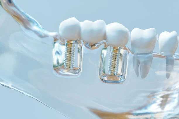 Are Dental Implants Covered by Insurance?
