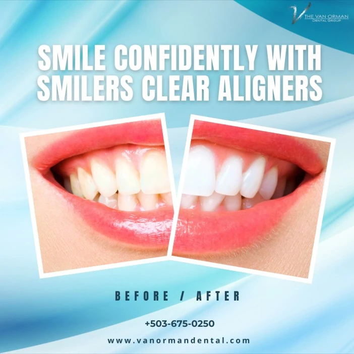 Are Smilers Clear Aligners Right for You ?