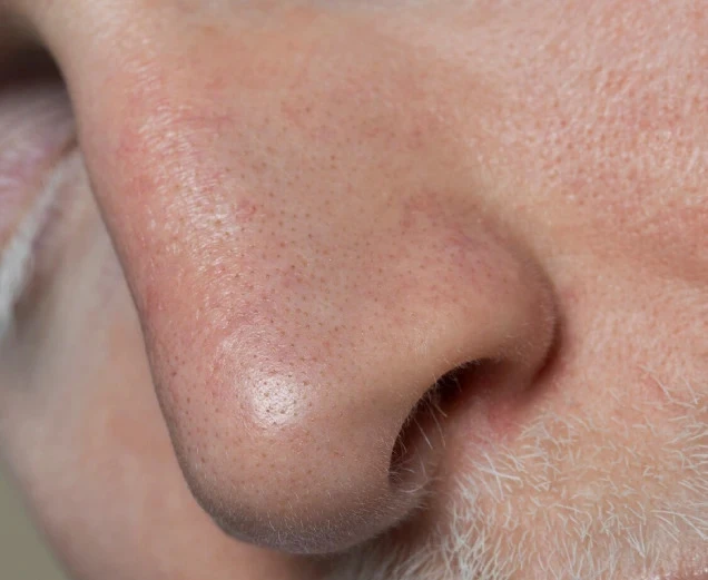 How To Close Open Pores on Face - Types, Causes, Treatment Methods