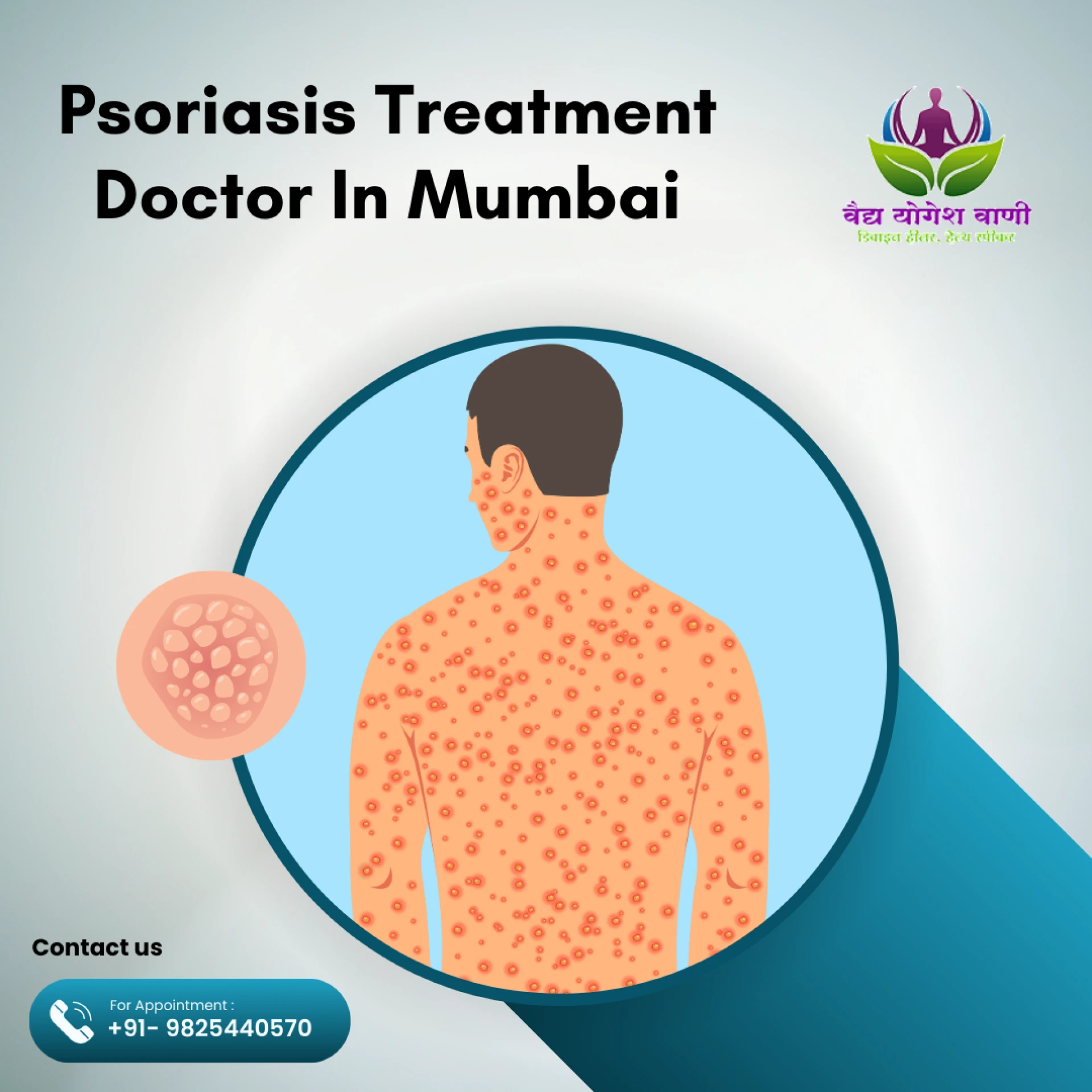 Can a Psoriasis Doctor in Mumbai Provide a Permanent Cure
