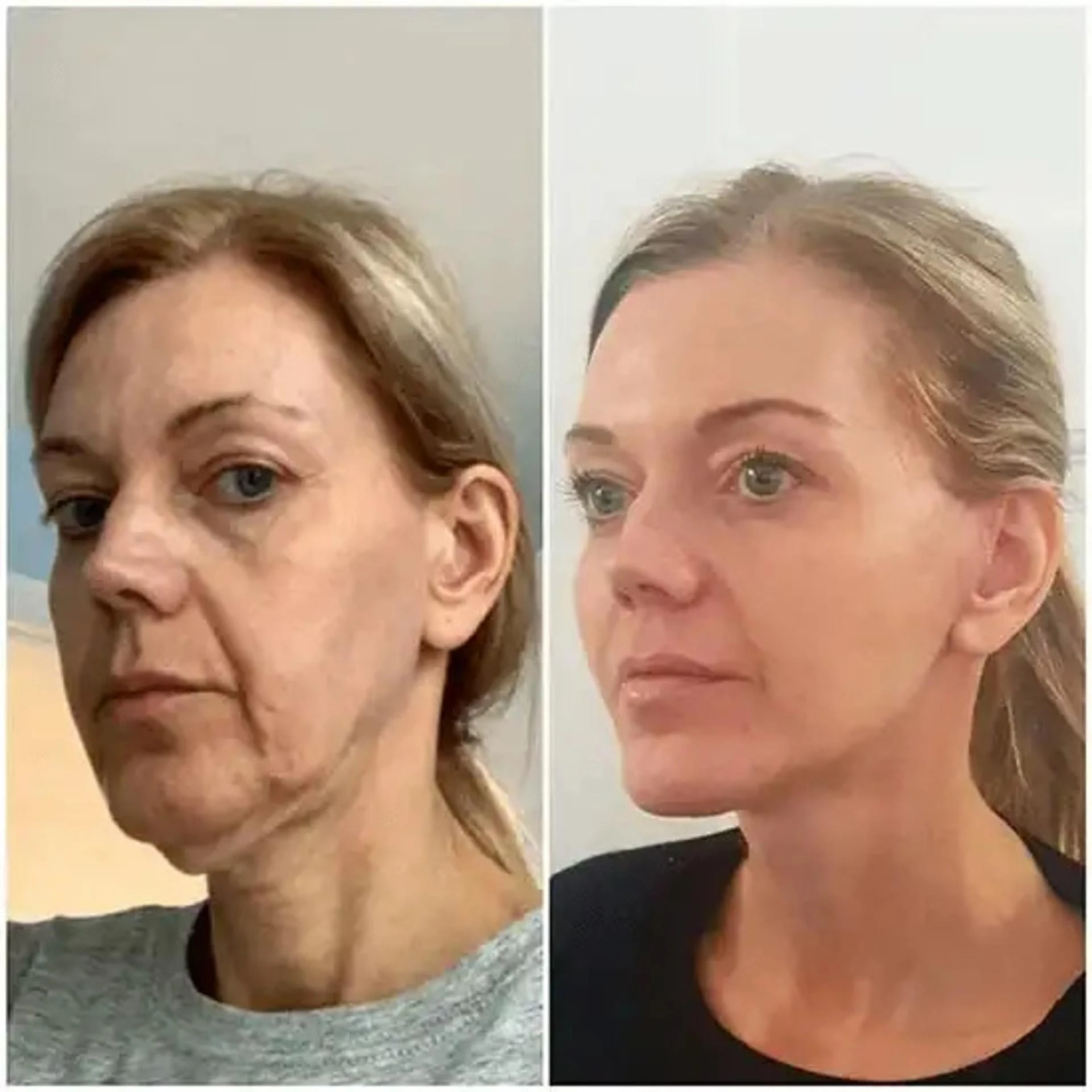 Why You Should Choose a Certified Breast Augmentation Surgeon in Dubai