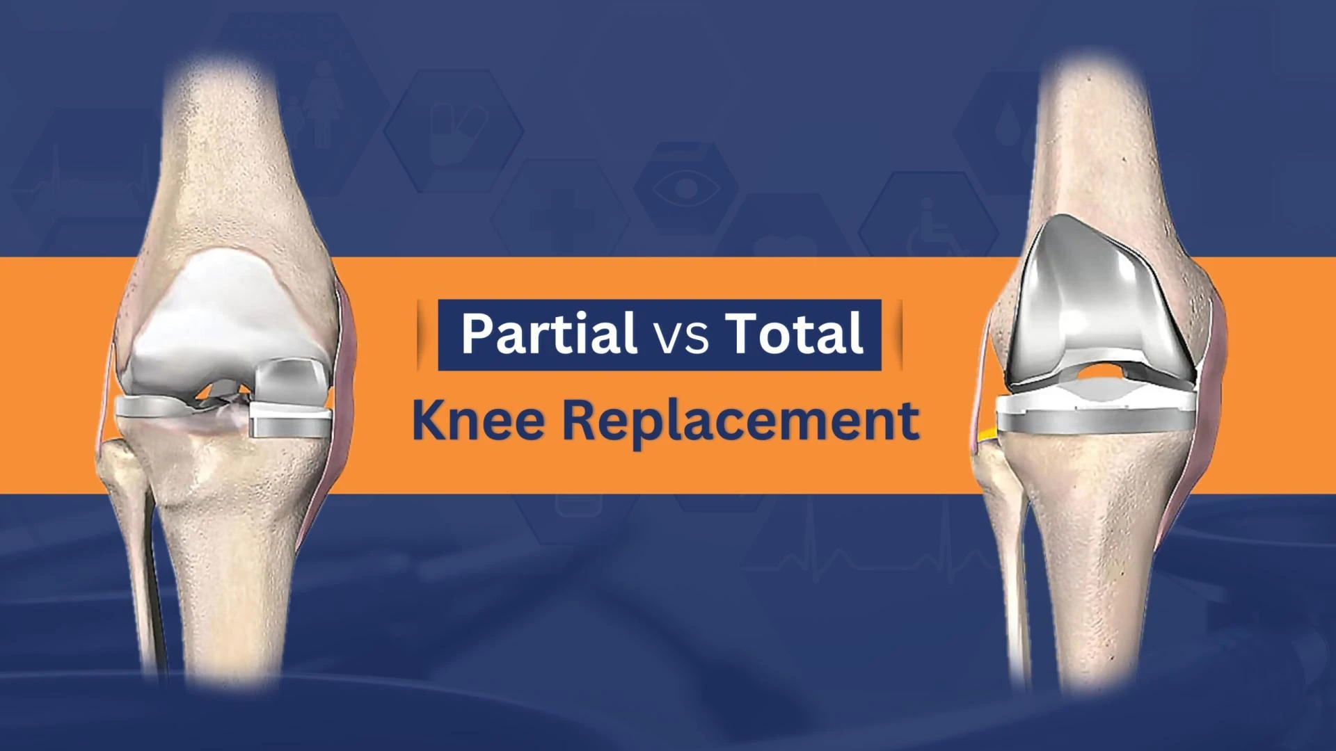 Partial vs. Total Knee Replacement: Understanding Your Best Treatment Option