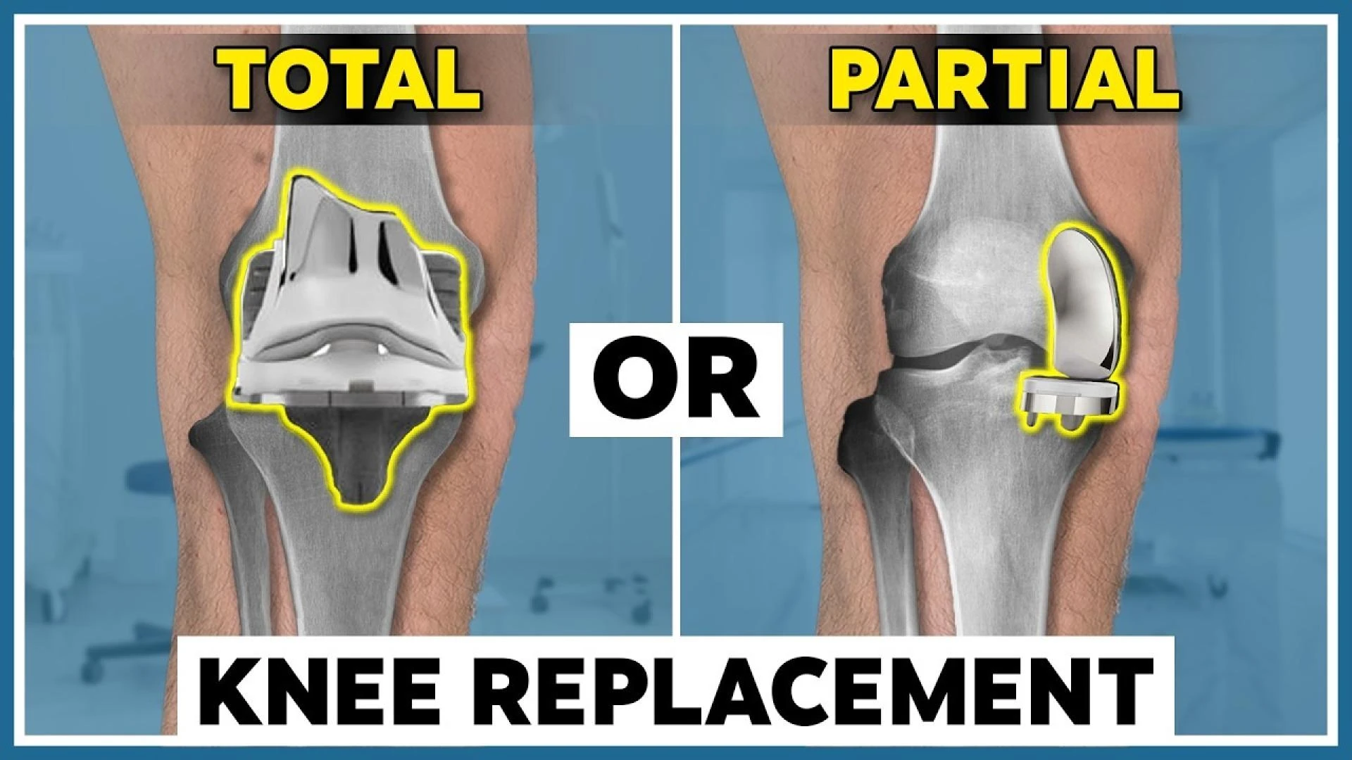 Partial vs. Total Knee Replacement: Understanding Your Best Treatment Option