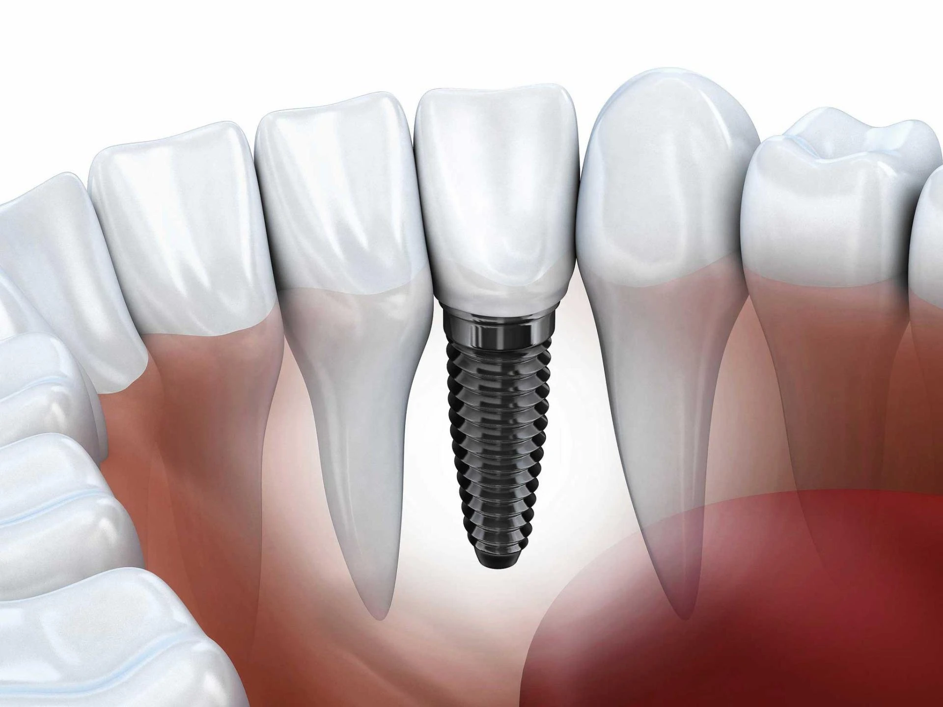 How Dental Implants Are Placed: The Procedure Explained