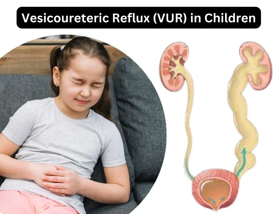 Vesicoureteral Reflux Surgery in Children: Expert Treatment in Delhi