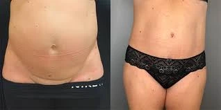 Achieving a Toned Core: Your Guide to Abdominoplasty in London