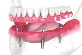 Dental Implants: How Long is the Process from Start to Finish?