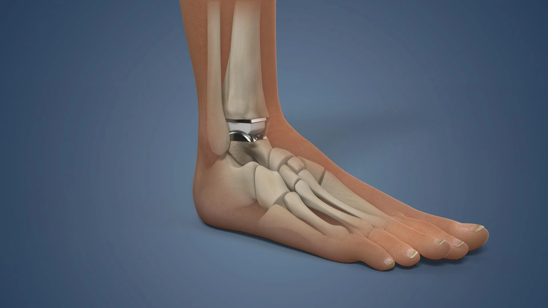 Understanding Persistent Pain After Total Ankle Replacement Surgery in Delhi