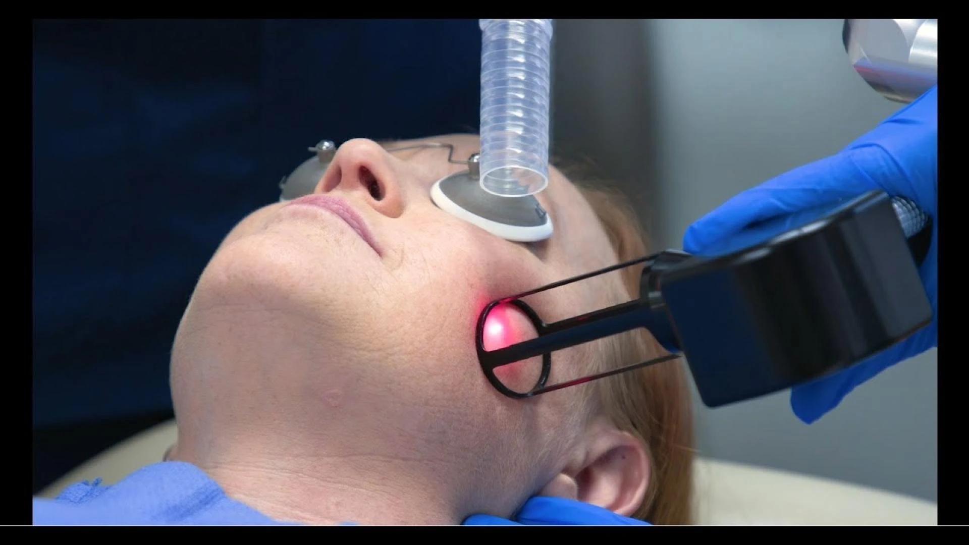 Rejuvenate and Renew: All About Fractional Resurfacing Treatment in Delhi