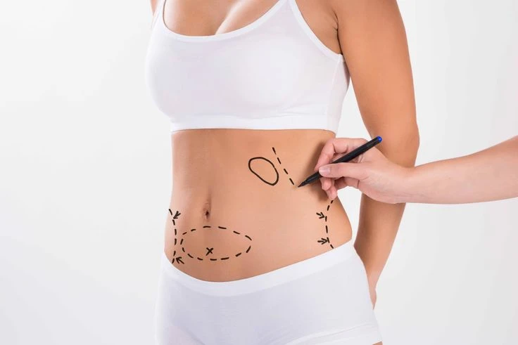 Avoiding Liposuction Complications in Islamabad: What You Need to Know