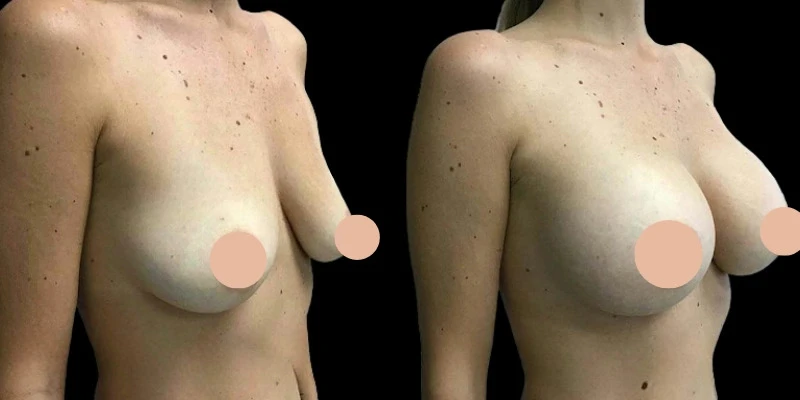 Meet the Best Breast Augmentation Surgeon in Dubai: Trusted by Thousands