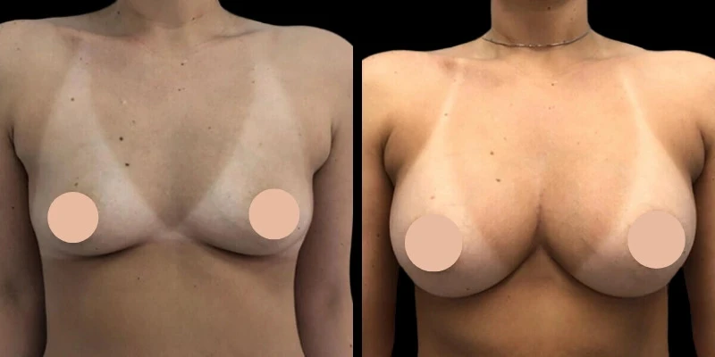 Thinking About Breast Augmentation in Dubai? Read This First