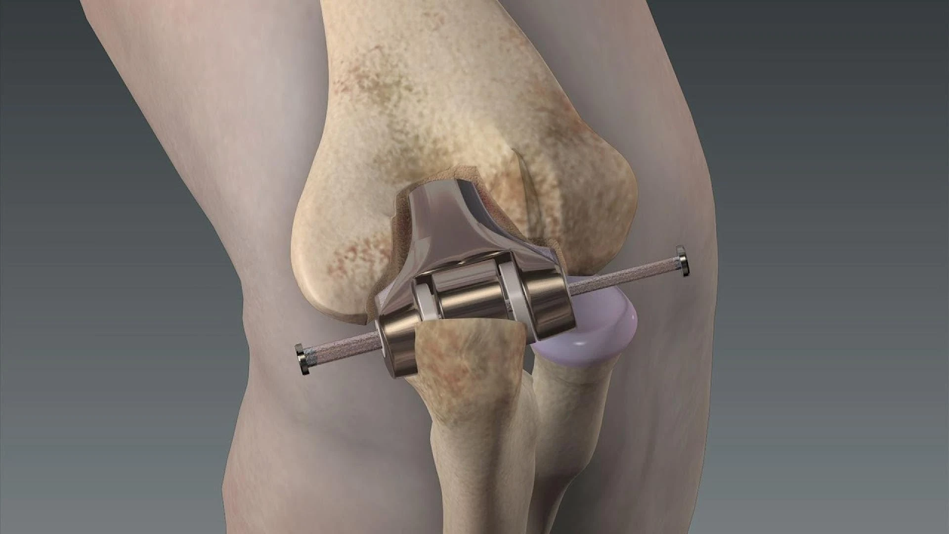 Modern Solutions for Elbow Joint Issues: Total Elbow Replacement Surgery in Delhi