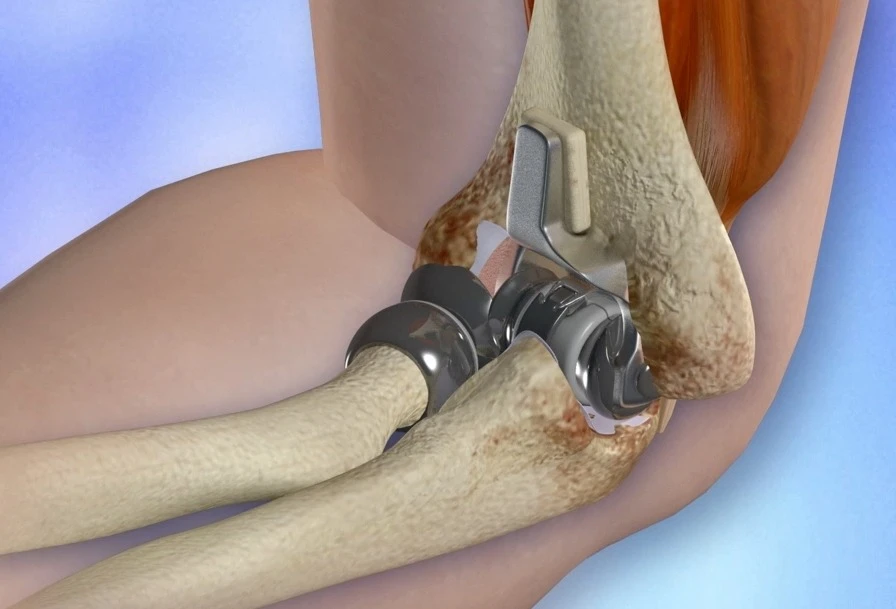 Modern Solutions for Elbow Joint Issues: Total Elbow Replacement Surgery in Delhi