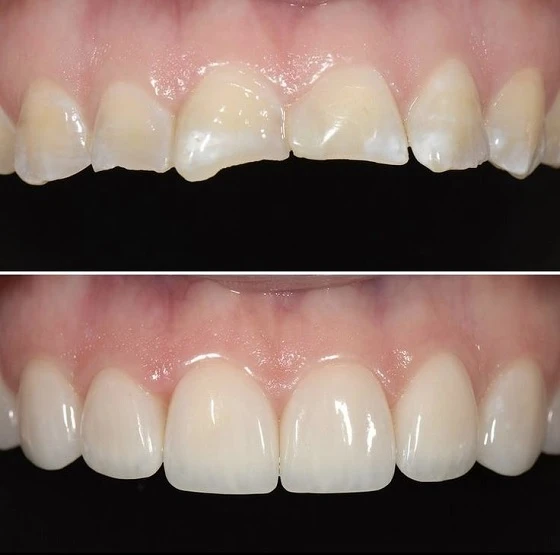 A Practical Guide to Crown Dental Treatment