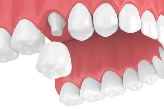 A Practical Guide to Crown Dental Treatment