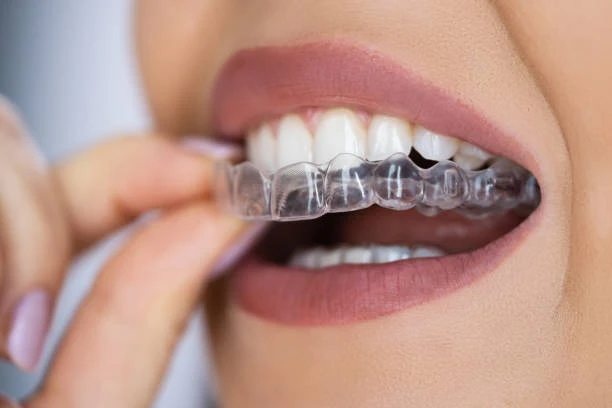 What to Expect During Your Smilers Clear Aligners Journey