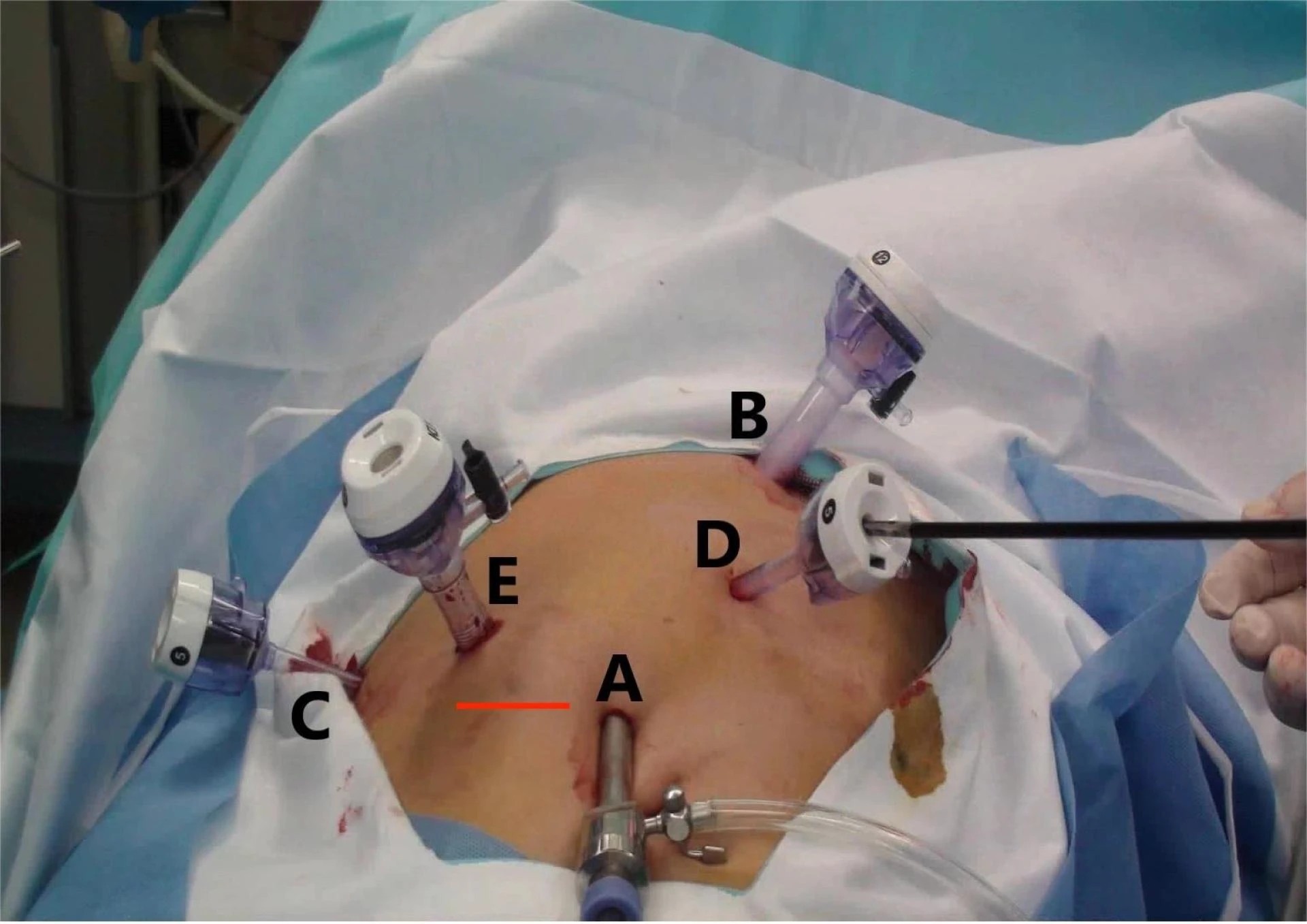 Expert Hepatobiliary Care: Meet the Best Laparoscopic Surgeons in Delhi