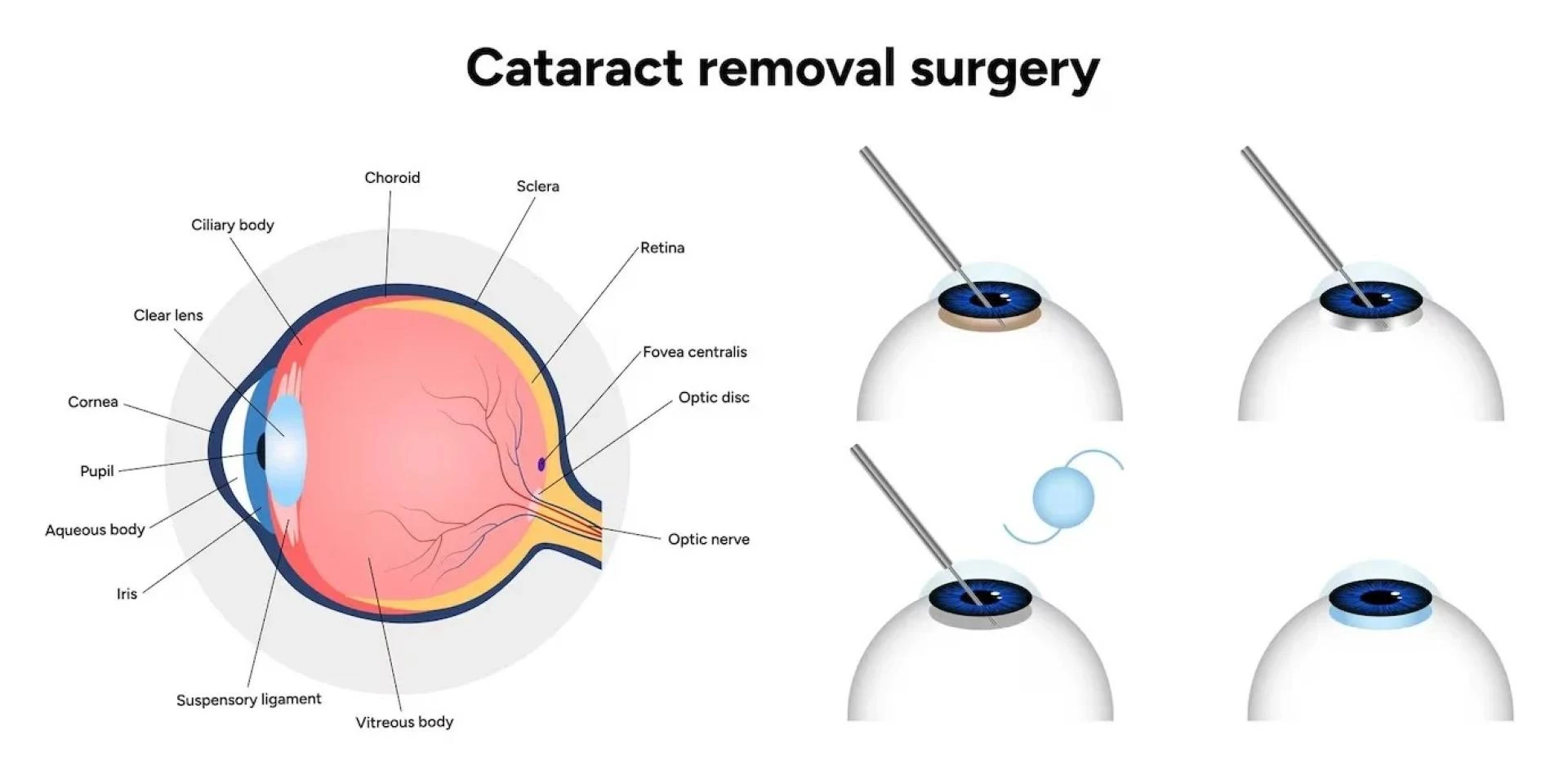 Bladeless Cataract Surgery in Ghatkopar: Advanced, Safe & Vision-Restoring