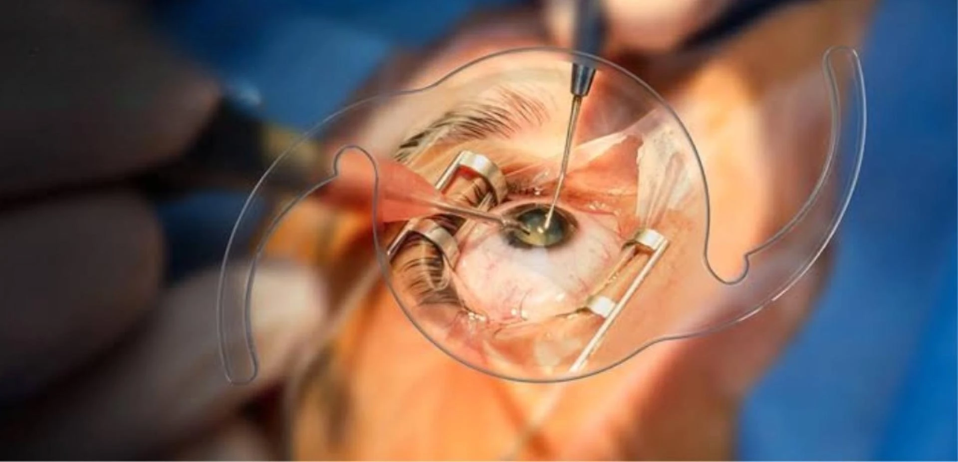 Bladeless Cataract Surgery in Ghatkopar: Advanced, Safe & Vision-Restoring