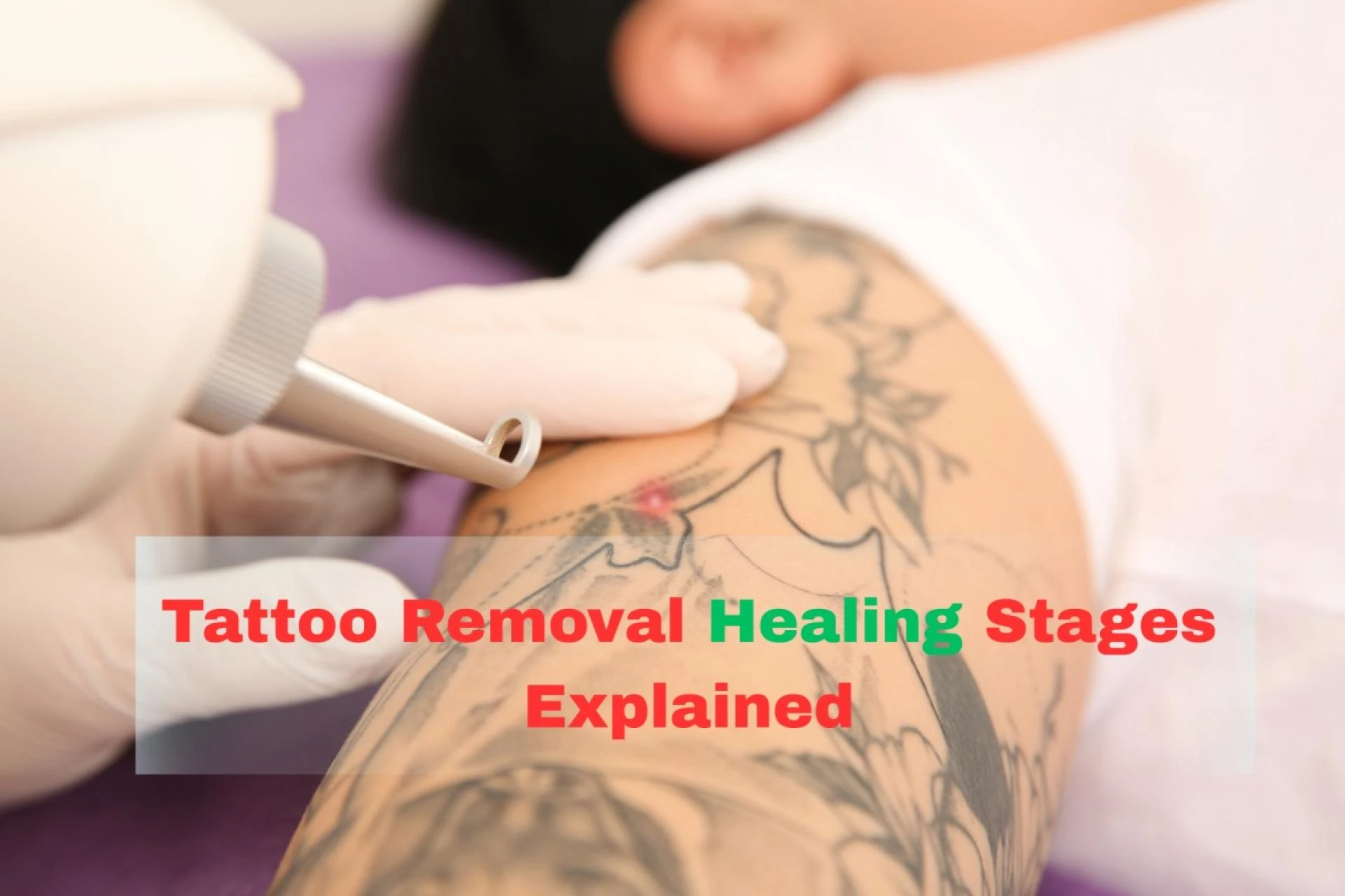 Tattoo Removal Healing Stages Explained