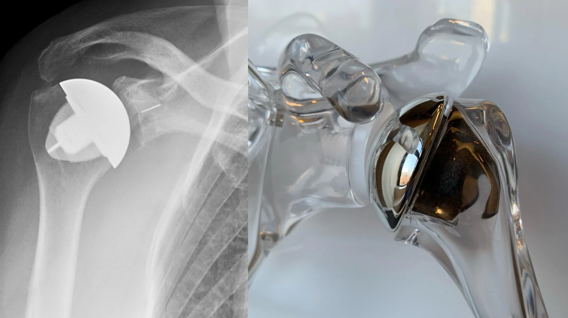 Shoulder Replacement Surgery in Delhi: A Game-Changer for Pain-Free Living