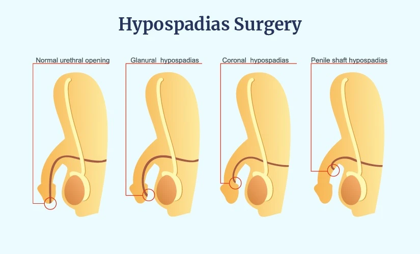 Understanding Hypospadias Surgery and Its Complications: A Guide for Parents