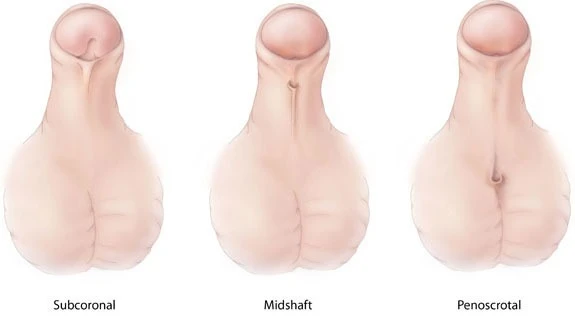 Understanding Hypospadias Surgery and Its Complications: A Guide for Parents