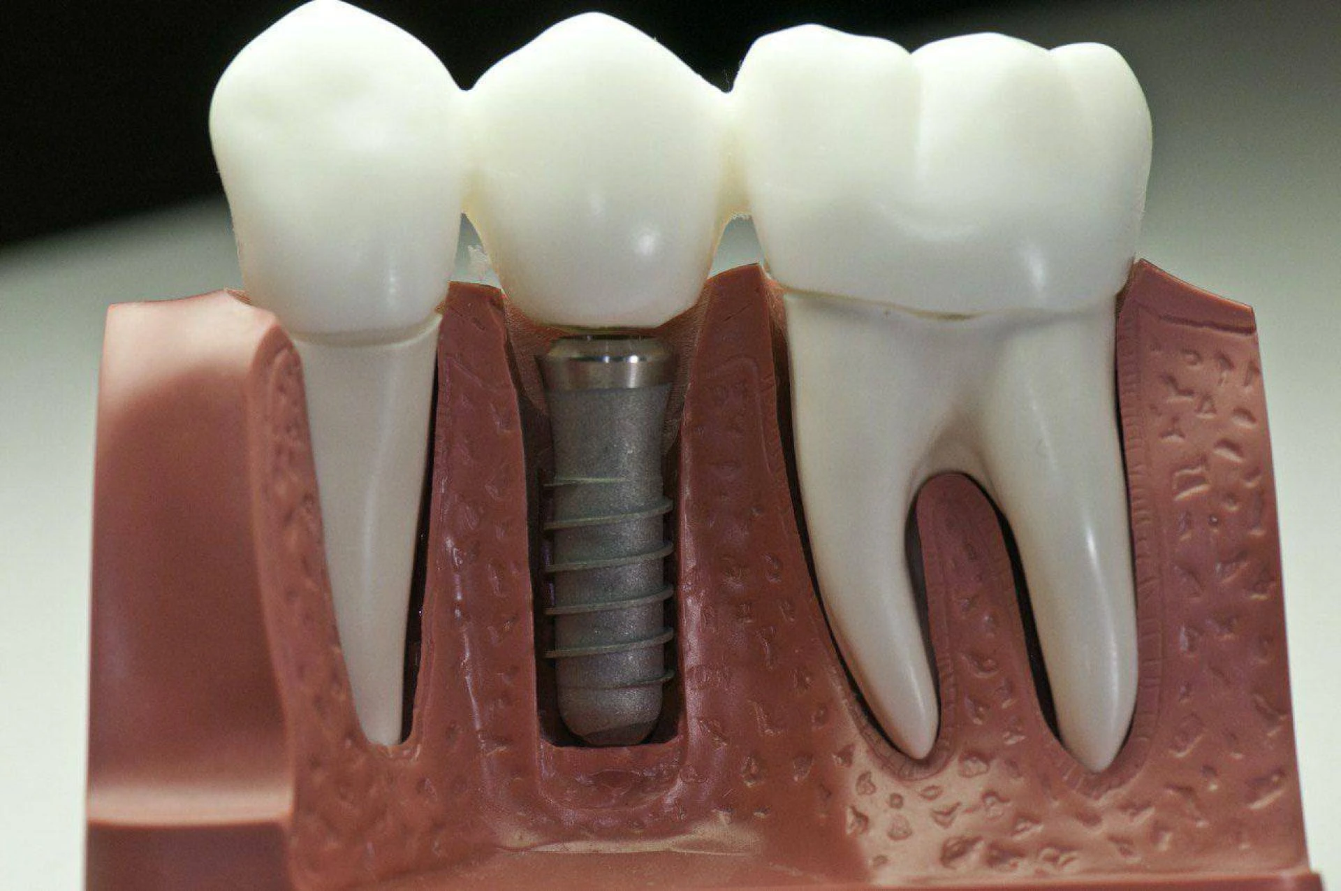 Expert Bone Graft Treatment in Ahmedabad for Stronger Smiles