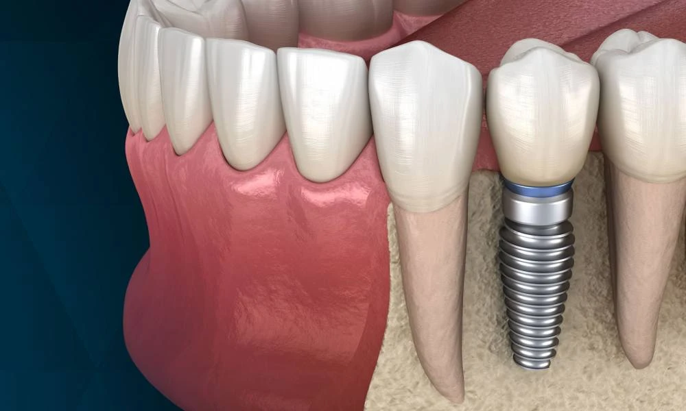 Expert Bone Graft Treatment in Ahmedabad for Stronger Smiles