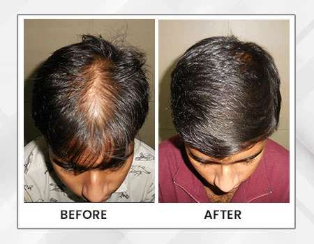 Reversing Hair Fall: Kolkata’s Modern Approach to a Timeless Concern