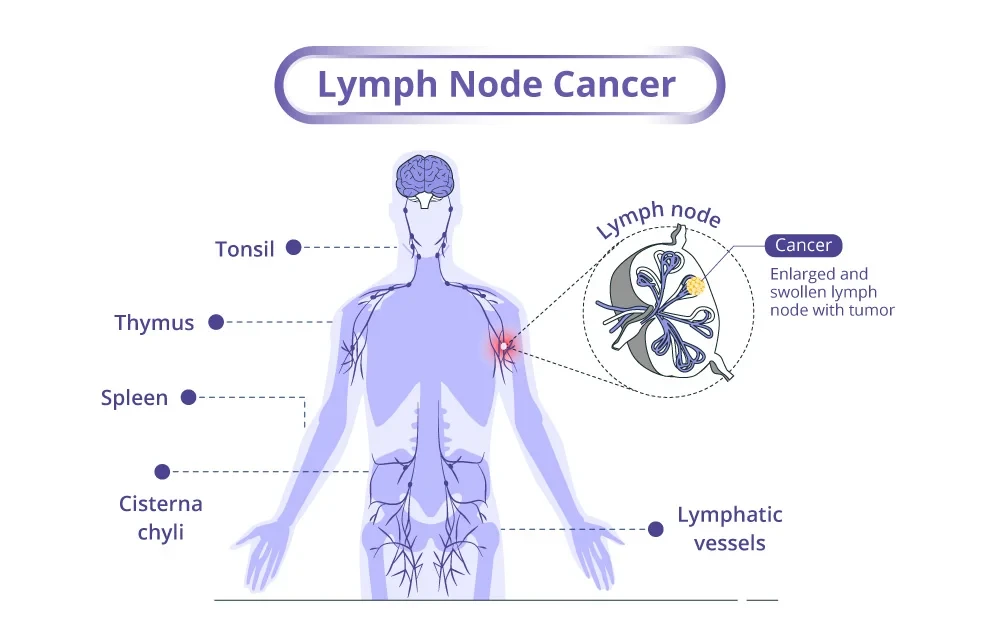 How bad is lymphoma cancer?
