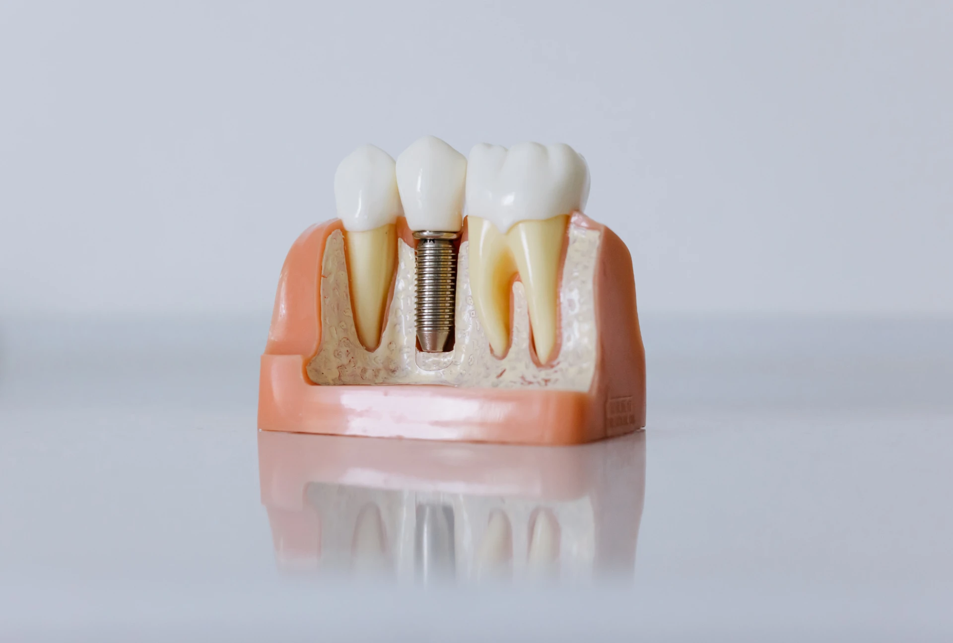 Dental Veneers: Transforms and Enhances Your Smile