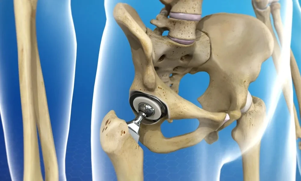 Complete Guide to Recovery After Total Hip Replacement Surgery in Delhi
